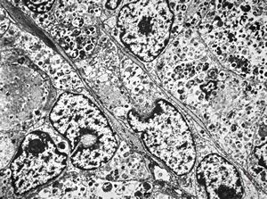 F,30y. | granular cell tumor F,30y. | granular cell tumor
